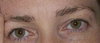 Blepharoplasty or Brow lift for female Patient in Early 20’s? - Featured Image