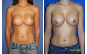 before and after results of female patient
