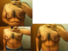 Male patient collage before gynecomastia surgery