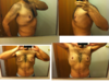 Male patient collage after gynecomastia surgery
