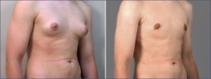 Male patient before and after gynecomastia surgery