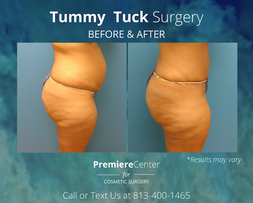 How Much Does a Tummy Tuck Cost? Tummy Tuck Pricing