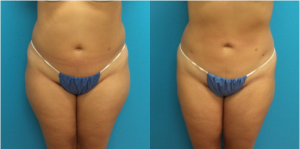 Before and After Liposuction