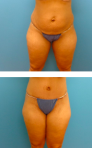 Premiere Tummy Tuck Patient