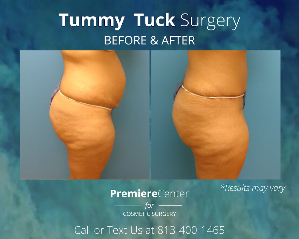 Before and after image showing the results of a tummy tuck performed in Tampa, FL.