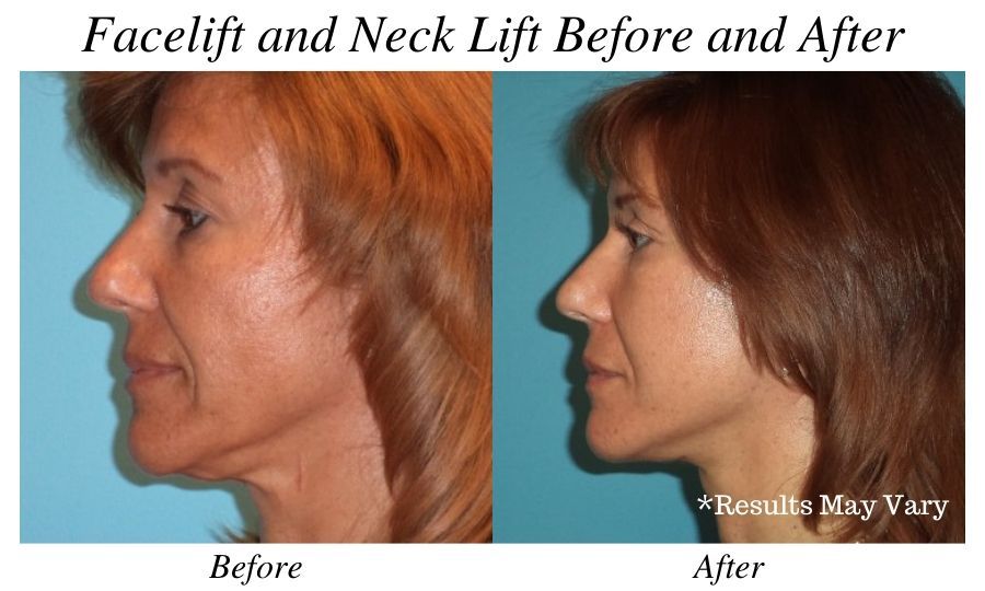 Before and after image showing the results of a facelift and neck lift surgery performed in Tampa, FL.