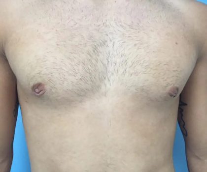 Gynecomastia Before & After Patient #448