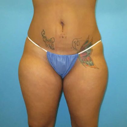 Liposuction Before & After Patient #486