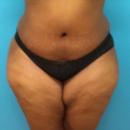 Tummy Tuck Before & After Patient #85