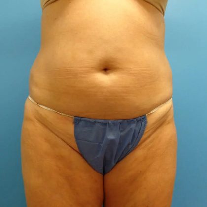 Coolsculpting Before & After Patient #339