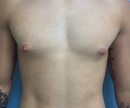 Gynecomastia Before & After Patient #448