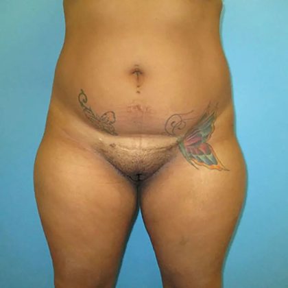 Liposuction Before & After Patient #486