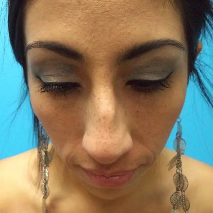 Rhinoplasty Before & After Patient #619