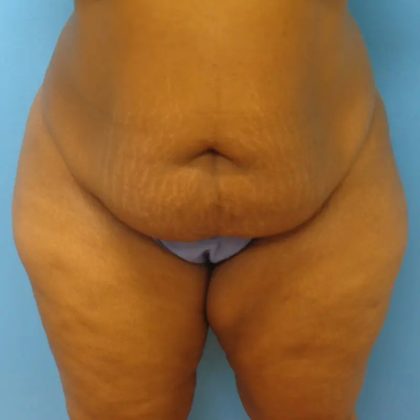 Tummy Tuck Before & After Patient #85