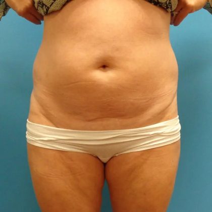 Coolsculpting Before & After Patient #339